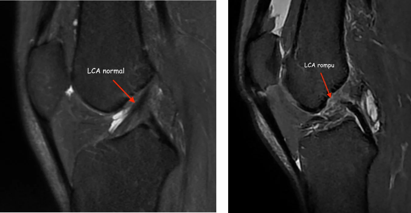 Imagerie rupture ligament croisé antérieur