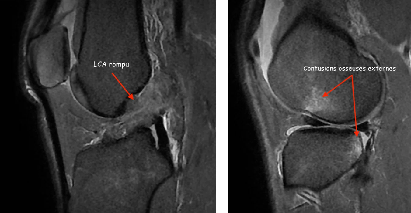 Imagerie rupture ligament croisé antérieur