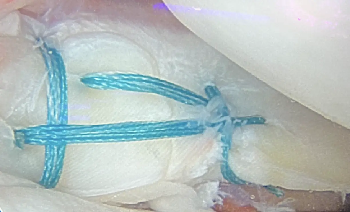 Réparation méniscale par sutures sous arthroscopie lors d'une reprise du LCA