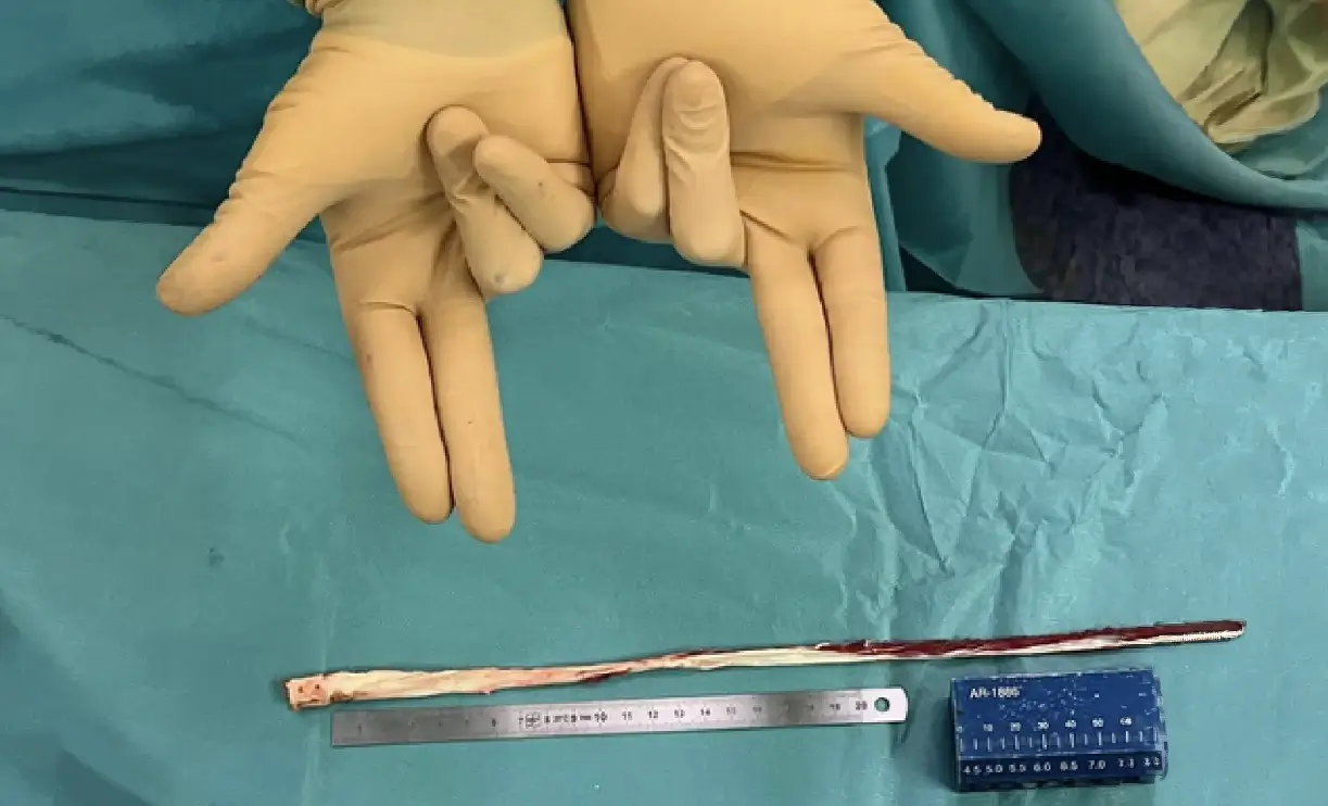 Greffe continue os-tendon quadricipital-rectus femoris prélevée pour une reprise du LCA